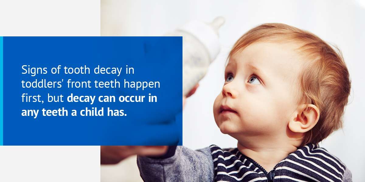 what is baby bottle tooth decay