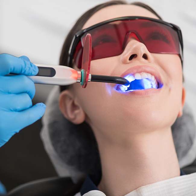 UV Light Curing on Teeth